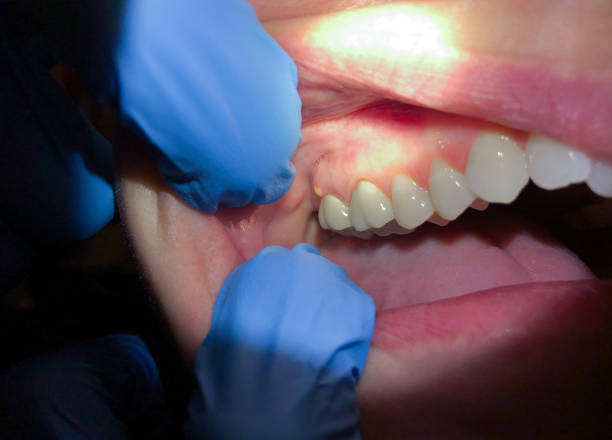 Best Emergency Wisdom Tooth Extraction in East Glenville, NY